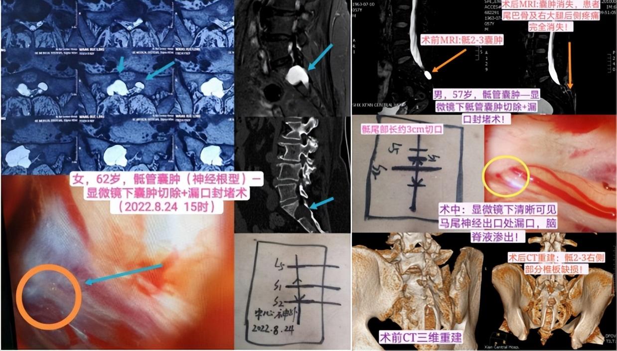 骶管囊肿最新治疗方法详解，探索与理解