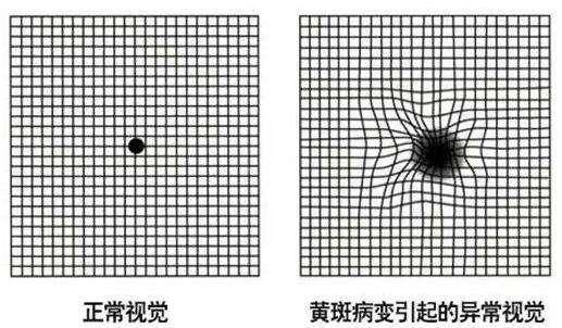 黄斑病变最新特效药研究与应用进展